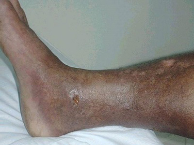 Gravitasyonel Egzama, Staz Dermatitis, Venöz Egzama