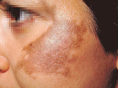 Melazma (Melasma)