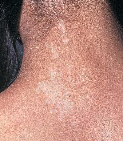 depigmente_nevus.jpg