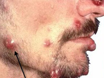Basiller Anjiyomatozis (Bacillar Angiomatosis)