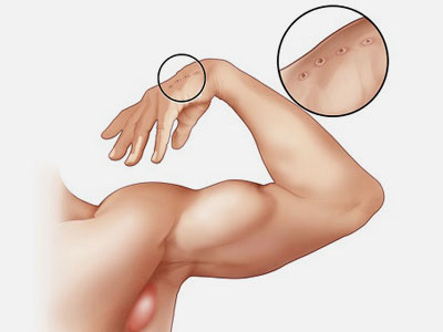 Kedi Tırmığı Hastalığı, Cat Scratch Disease