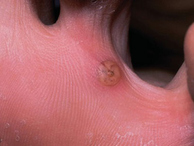 Tungiasis ve Neden Olduğu Cilt Reaksiyonları