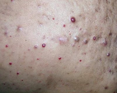 Bacillary Angiomatosis (Basiller Anjiyomatozis)