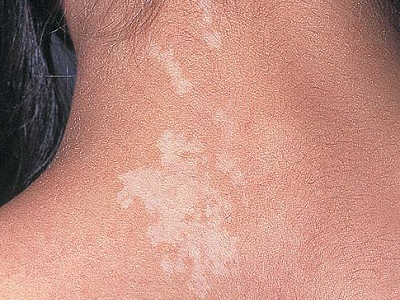 Depigmente Nevus, Akromik Nevus