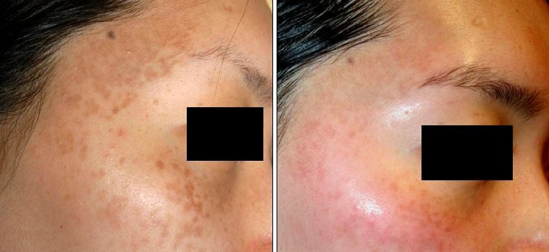 Hori Nevus, Horinin Beni