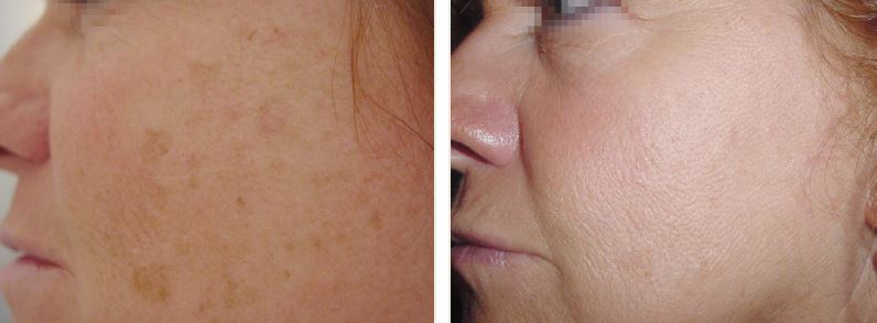 Lentigo, Güneş lekeleri,Ciltte Lekeler, Lazer Uygulamaları