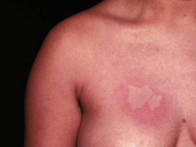 Nevus Anemikus