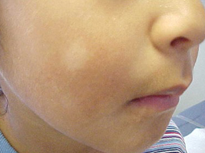 Pityriasis Alba, Pitriazis alba 