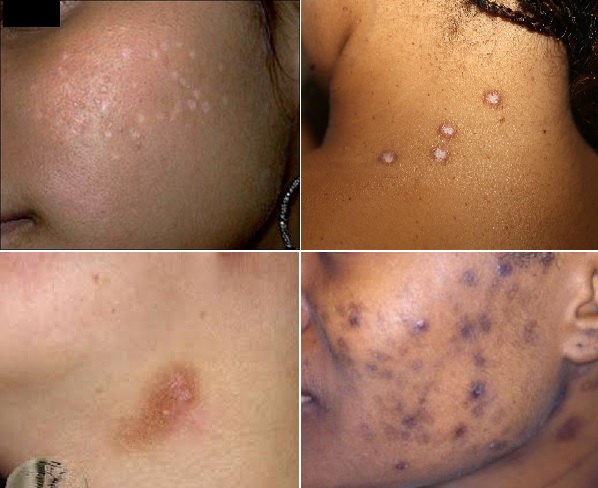 Postinflamatuar hiperpigmentasyon, hipopigmentasyon