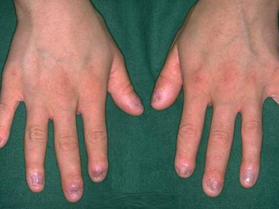 Ektodermal Displazi