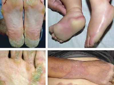 Avuç içleri ve Ayak tabanlarında Keratoderma,  Kalıtsal palmoplantar keratoderma