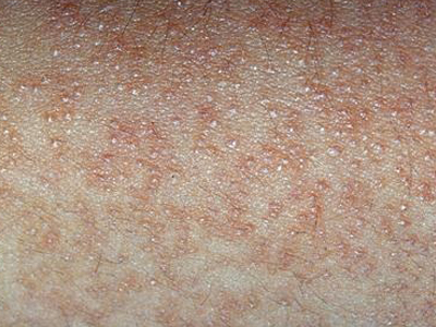 Keratosis pilaris, Keratoz pilaris, Pilar Keratozis
