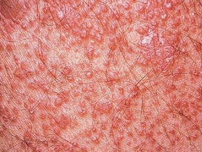 Pityriasis Rubra Pilaris