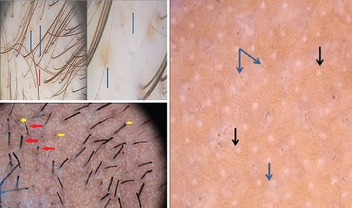 Trikoskopi (Trichoscopy)
