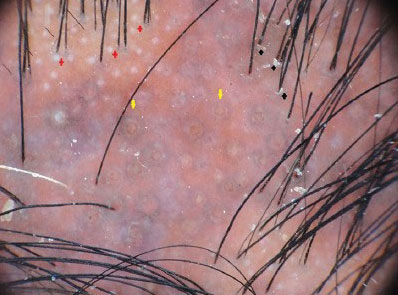 Saçlı deri ve saç hastalıklarının tanısında Trikoskopi (Trichoscopy)