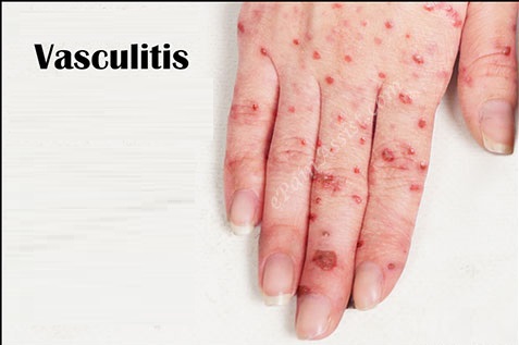 Vaskülitler ve Deri Bulguları