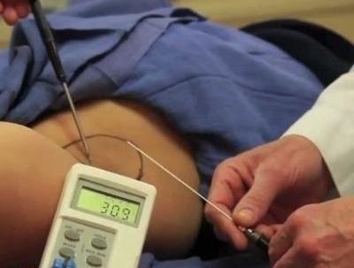 Hiperhidrozis Ultrasound Tedavisi