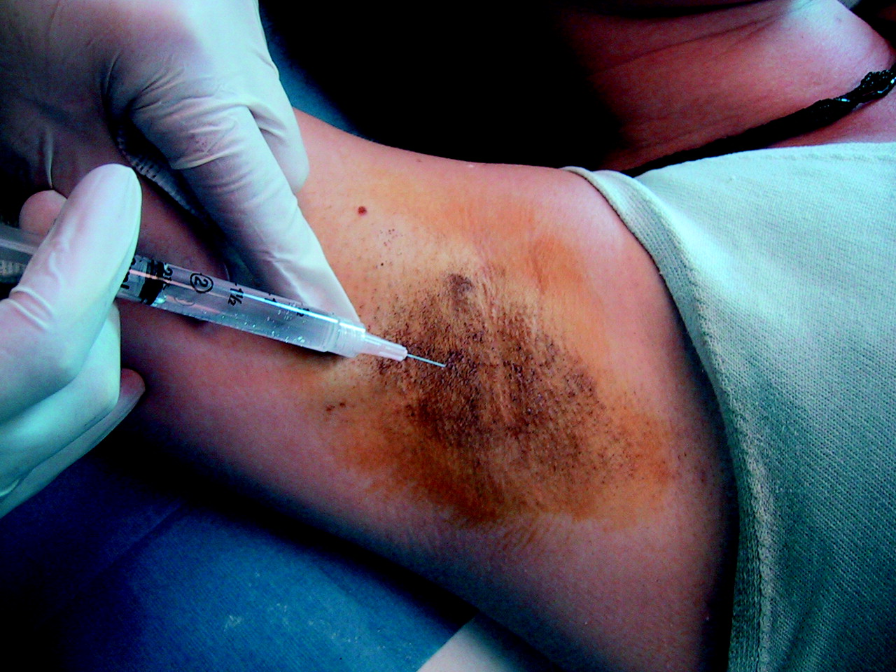 Aşırı Terleme, Hiperhidrozis, Botoks(Botulinum Toksin) Uygulaması