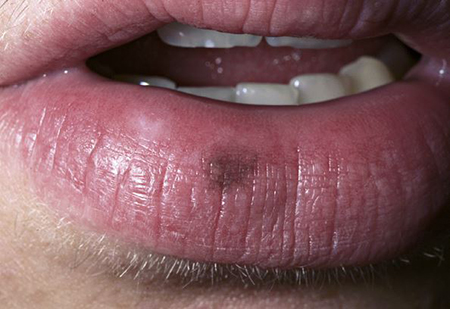 Dudaklara Yerleşen Melanotik Makül (Labial Malenotic Macule)