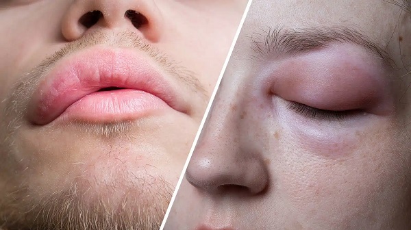 Anjiyoödem, Anjioödem, Angioedema