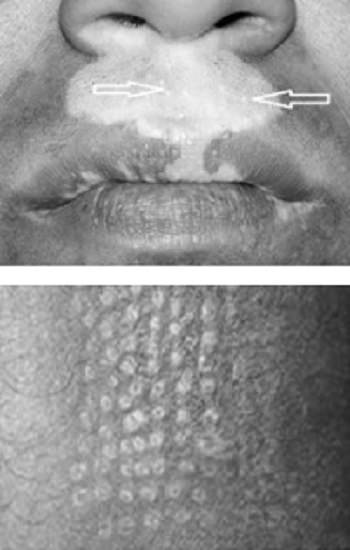 Vitiligo'da Cerrahi Yöntemler Kimlere Uygulanabilir?