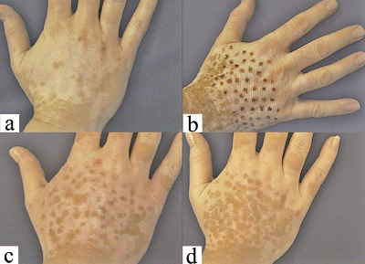 Vitiligo'da Kombine Tedaviler