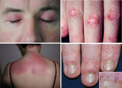 Dermatomiyozit Cilt Bulguları Tanı ve Tedavi