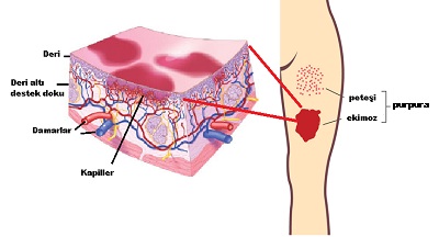 ekimoz-purpura-lazer-uygulamalari.jpg