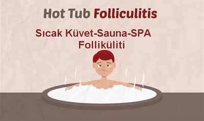 SPA Foliküliti, Sıcak Banyo Foliküliti (Hot Tub Foliküliti), Sıcak El Ayak Sendromu