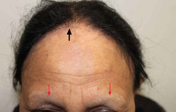 Frontal Fibrosing Alopesi 