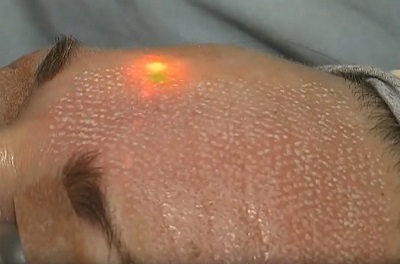 Ablatif CO2 Lazer Parametrelerinin Anlamı 