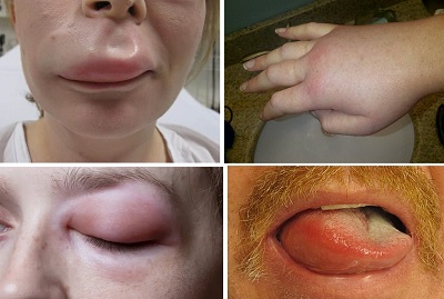 Anjiyoödem, Angioedema