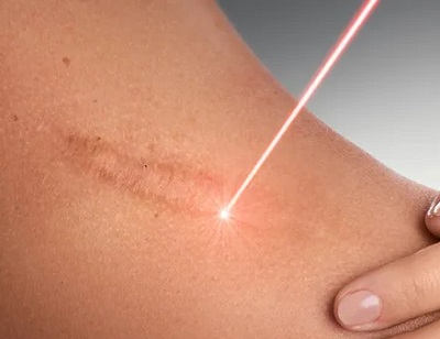 Deri Greft Cerrahi Uygulamaları Sonrası İzlerde Fraksiyonel CO2 Lazer 