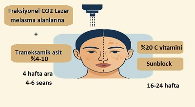 Melasma Tedavisinde Fraksiyonel CO2 Lazer Topikal Traneksamik Asit ve Askorbik Asit  