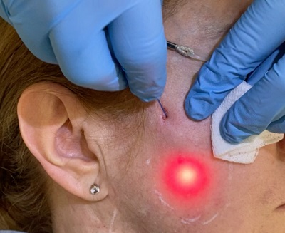 Atrofik Akne İzlerinde Fraksiyonel CO2 Lazer ve Subsizyon Birlikteliği