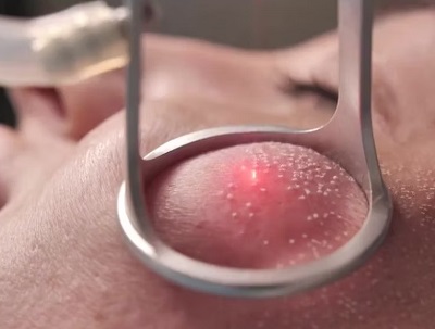 Akne İzlerinde Fraksiyonel CO2 Lazer ve Dolgu Uygulamaları 