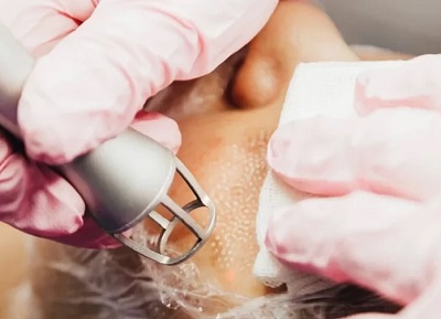 Androgenetik Alopesi AGA Fraksiyonel CO2 Lazer ve Topikal Tedaviler