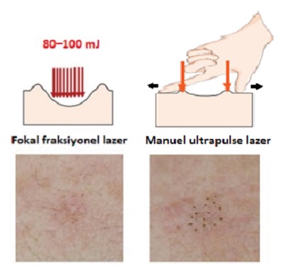 Atrofik Akne İzlerinde Fraksiyonel CO2 Lazer için Yeni Bir Protokol 