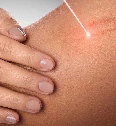 Cerrahi Sonrası Gelişen Skar Yönetiminde Fraksiyonel CO2 Lazer 