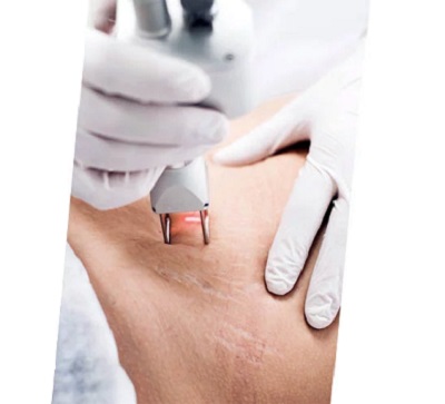 Cilt Çatlaklarında Fraksiyonel CO2 Lazer 