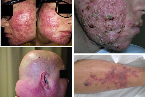 Fulminans Dermatozlar