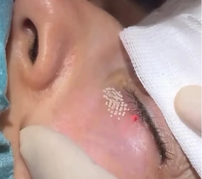 Göz Çevresi Kırışıklıklar ve Gençleştirme İçin Fraksiyonel Karbondioksit Lazer