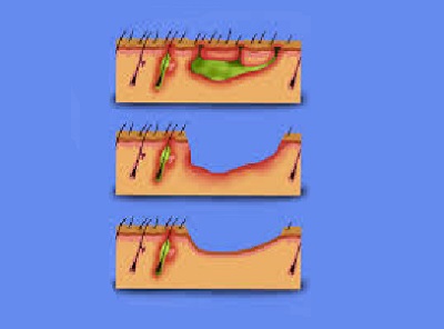 Hidradenitis Suppurativa Tedavisinde Deroofing Cerrahi Tekniği