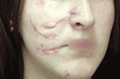 Hipertrofik Skarlarda Fraksiyonel CO2 Lazer 