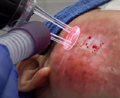 Hipertrofik Skarlarda Fraksiyonel CO2 Lazer ve IL Enjeksiyon İlaçlar