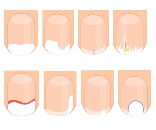 Onikolizin Klinik Formundan Tanıya