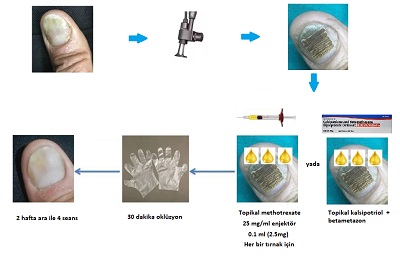 Tırnak Sedef Hastalığının Tedavisinde Fraksiyonel CO2 Lazer ve Topikal İlaçlar