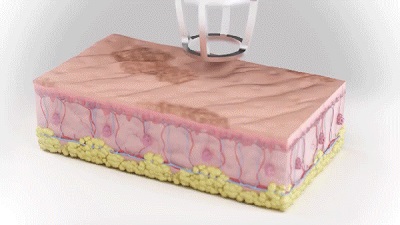 Vitiligo Tedavisinde Fraksiyonel CO2 lazer 