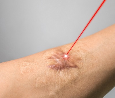 Yanık İzlerinin Tedavisinde Fraksiyonel CO2 Lazerin Stromal Vasküler Fraksiyon (SVF) 