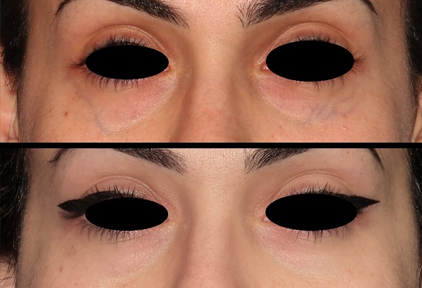 goz_alti_koyu_halkalari_periorbital_hiperpigmentasyon_tedavisi_damarsal_lazerler.jpg